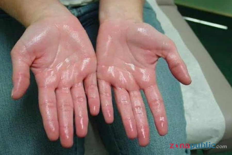 Hiperhidrosis Apakah Berbahaya? Kupas Tuntas Fenomena Keringat Berlebih